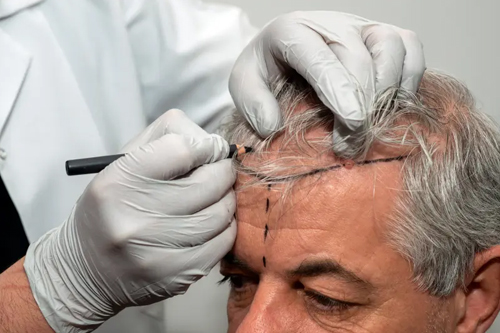 Top Hair Transplant Treatment in Thane